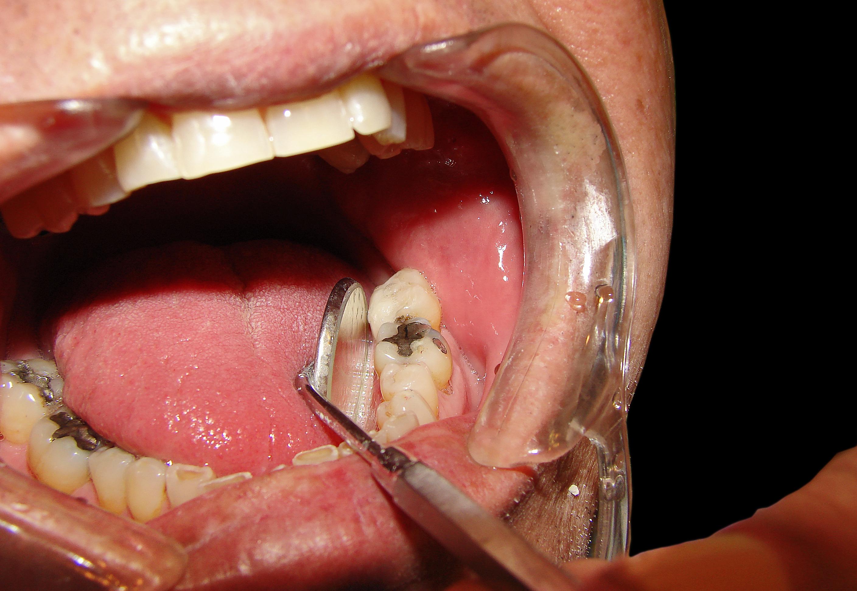 Geralmente dentista não suspeita da lesão inicial do câncer oral (Foto: Free Images)