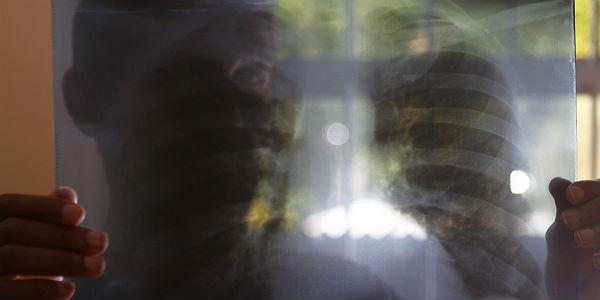 Imagem ilustrativa de tuberculose (Foto: Marcos Pastich / Acervo JC Imagem)