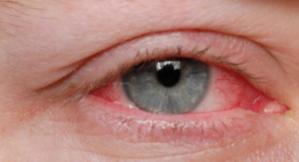 Ácaros, poeira e fumaça podem favorecer o aparecimento da alergia ocular (Foto: Reprodução)