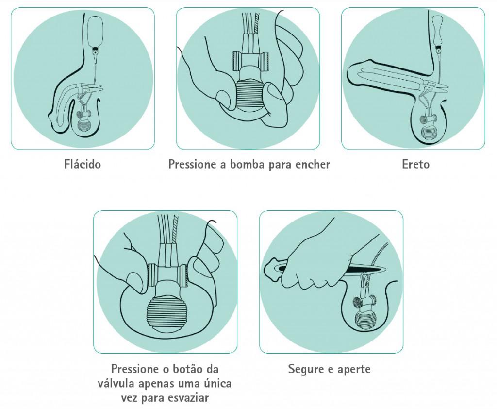Veja como manusear a prótese inflável (Infográfico: Divulgação)