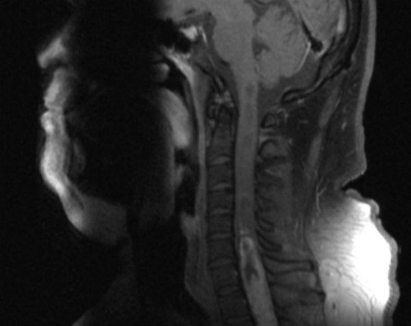 Radiografia do tumor raro (Imagem: PLoS One) 