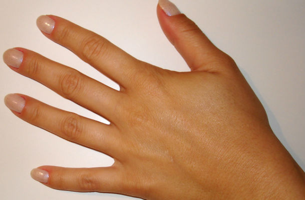 Há vários tipos de psoríase, como a ungueal, que afeta os dedos das mãos e dos pés, como também as unhas (Foto: Free Images)