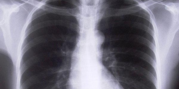 Imagem ilustrativa de raio X de pulmões (Foto: Free Images)
