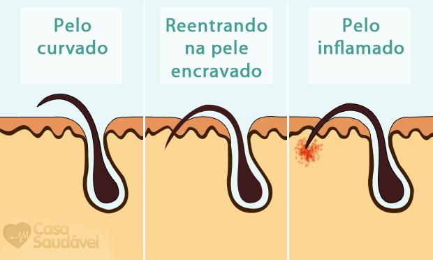 Imagem da diferença entre os pelos (Ilustração: Guilherme Castro / NE10)