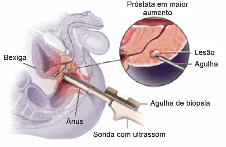 Arte da biópsia da próstata