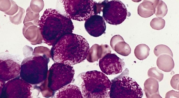 Estratégia está sendo testada em humanos no tratamento da leucemia mieloide aguda; resultados preliminares foram apresentados durante o congresso Next Frontiers to Cure Cancer (Imagem: Wikimedia Commons)