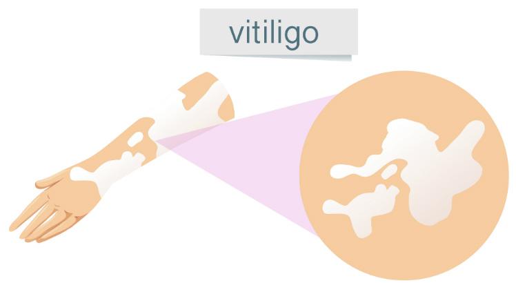 Vitiligo é uma doença não contagiosa caracterizada por perda da coloração da pele, em virtude da destruição dos melanócitos, células que formam a melanina, pigmento que dá cor à pele (Imagem: Freepik)