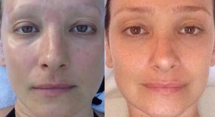 Sabrina Parlatore em fotos tiradas há um ano atrás, quando encerrava as sessões de quimioterapia, e agora - Foto: reprodução do Instagram