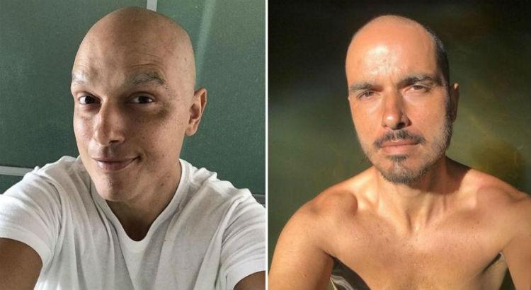 Léo Rosa durante e depois do tratamento do câncer - Crédito: Reprodução / Instagram